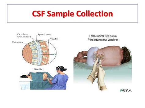 CSF Specimen Collection for Analysis 